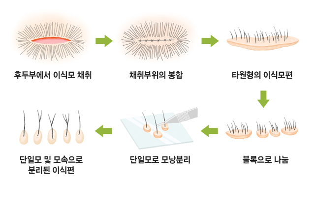 후두부에서 이식모 채취→채취부위의 봉합→타원형의 이식모편→블록으로 나눔→단일모로 모낭분리→단일모 및 모속으로 분리된 이식편