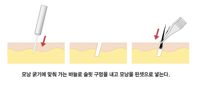 모낭 굵기에 맞춰 가는 바늘로 슬릿 구멍을 내고 모낭을 핀셋으로 넣는다.