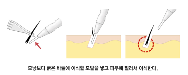 모낭보다 굵은 바늘에 이식할 모발을 넣고 피부에 찔러서 이식한다.