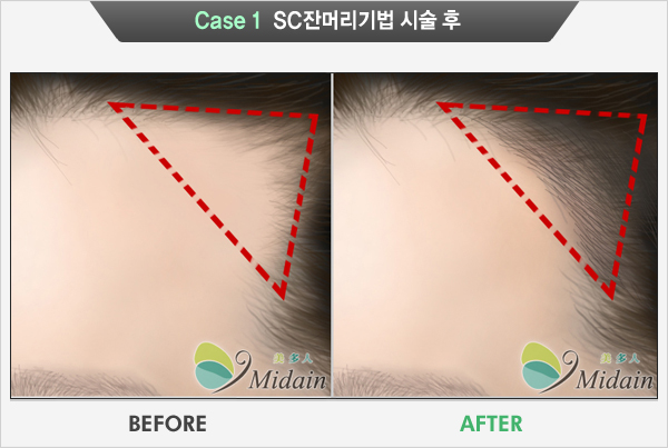 Case 1 SC잔머리기법 시술 후(BEFORE, AFTER)