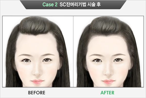 Case 2 SC잔머리기법 시술 후(BEFORE, AFTER)