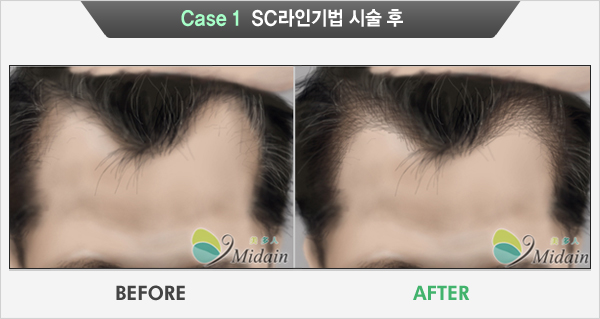 Case 1  SC라인기법 시술 후(BEFORE, AFTER)