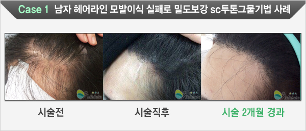 Case 1  남자헤어라인 모발이식 실패로 밀도보강 SC투톤그물기법 사례(시술전, 시술직후, 시술 2개월 경과)