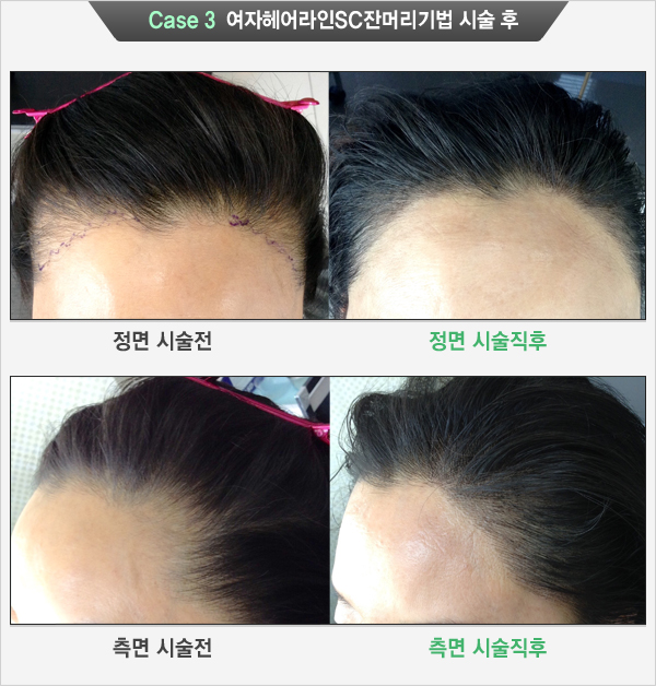 Case 3 여자헤어라인SC잔머리기법 시술 후(정면 시술전, 정면 시술직후, 측면 시술전, 측면 시술직후)