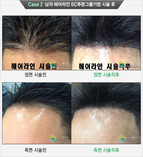 Case 2 남자 헤어라인 SC투톤그물기법 시술 후(정면 시술전, 정면시술직후, 측면 시술전, 측면 시술직후)