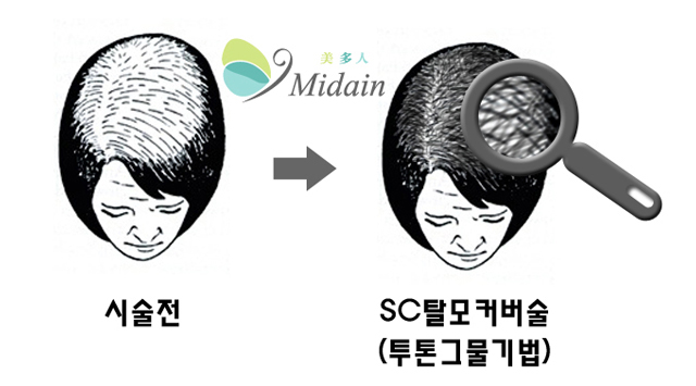 시술전→sc탈모커버술(투톤그물기법)