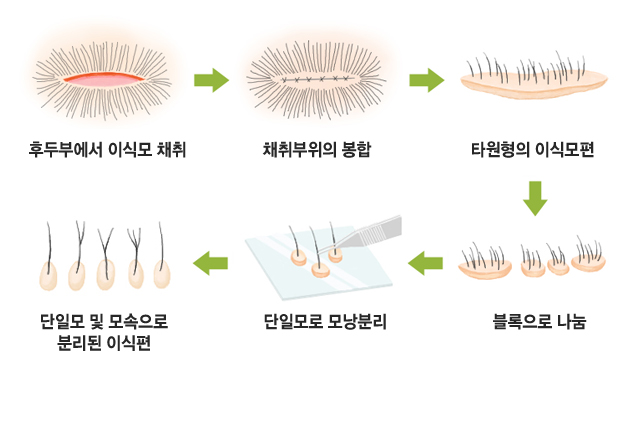 후두부에서 이식모 채취→채취부위의 봉합→타원형의 이식모편→블록으로 나눔→단일모로 모낭분리→단일모 및 모속으로 분리된 이식편