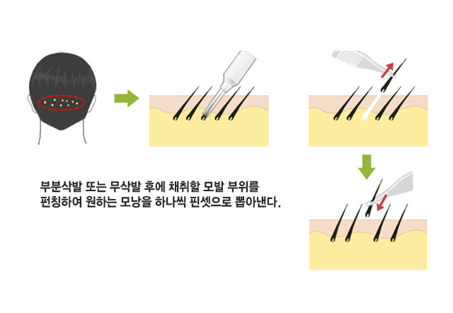 부분삭발 또는 무삭발 후에 채취할 모발 부위를 펀칭하여 원하는 모낭을 하났기 핀셋으로 뽑아낸다.