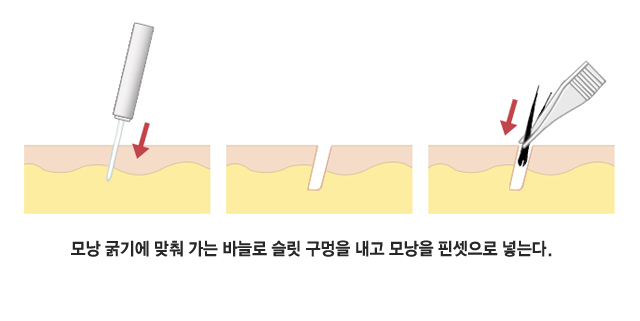 모낭 굵기에 맞춰 가는 바늘로 슬릿 구멍을 내고 모낭을 핀셋으로 넣는다.
