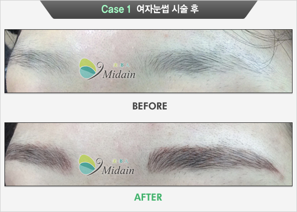Case 1  여자눈썹 시술 후(BEFORE, AFTER)