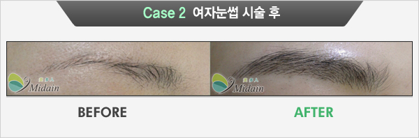 Case 2  여자눈썹 시술 후(BEFORE, AFTER)