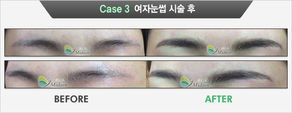 Case 3  여자눈썹 시술 후(BEFORE, AFTER)