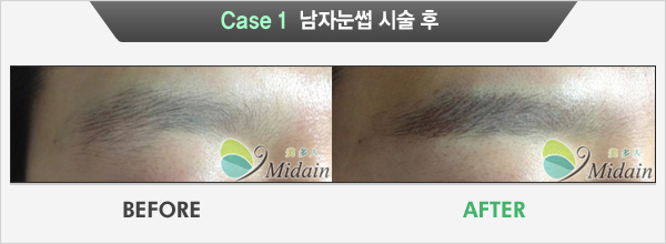 Case 1  남자눈썹 시술 후(BEFORE, AFTER)