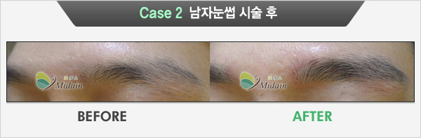 Case 2  남자눈썹 시술 후(BEFORE, AFTER)