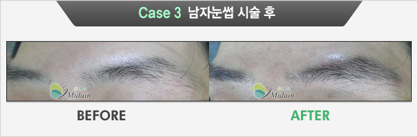 Case 3  남자눈썹 시술 후(BEFORE, AFTER)