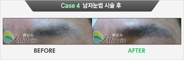 Case 4  남자눈썹 시술 후(BEFORE, AFTER)