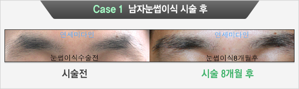 Case 1 남자눈썹이식 시술 후(시술전, 시술 8개월 후)