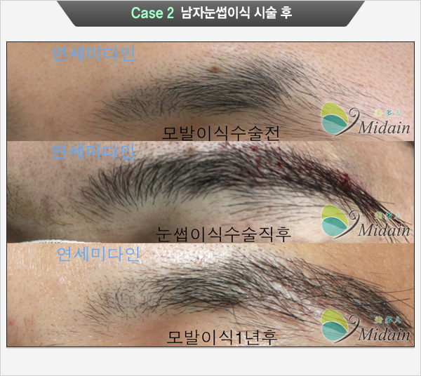 Case 2 남자눈썹이식 시술 후(모발이식수술전, 눈썹이식수술직후, 모발이식1년후)