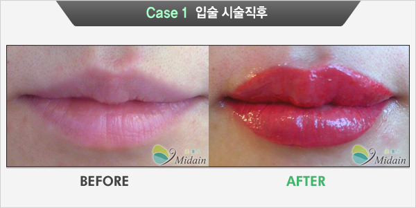 Case 1  입술 시술직후(BEFORE, AFTER)