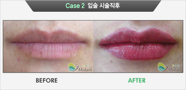 Case 2  입술 시술직후(BEFORE, AFTER)