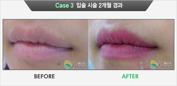 Case 3  입술 시술 2개월 경과(BEFORE, AFTER)