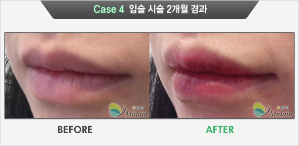 Case 4  입술 시술 2개월 경과(BEFORE, AFTER)