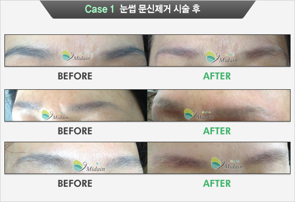 Case 1  눈썹 문신제거 시술 후(BEFORE, AFTER)