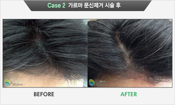 Case 2  가르마 문신제거 시술 후(BEFORE, AFTER)