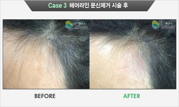 Case 3  헤어라인 문신제거 시술 후(BEFORE, AFTER)