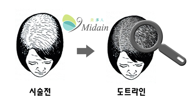 시술전, 시술 후 도트라인 이미지