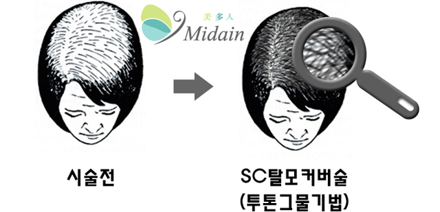 시술전, SC탈모커버술(투톤그물기법) 이미지