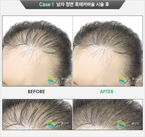Case 1  남자 정면 흑채커버술 시술 후(BEFORE, AFTER)