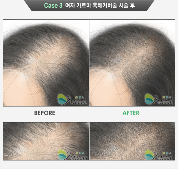 Case 3  여자 가르마 흑채커버술 시술 후(BEFORE, AFTER)