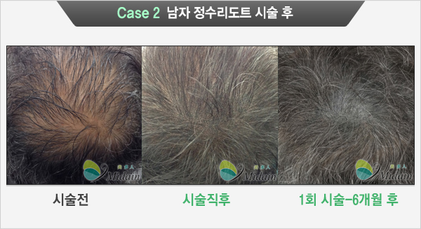Case 2  남자 정수리도트 시술 후(시술전, 시술직후, 1회 시술-6개월 후)
