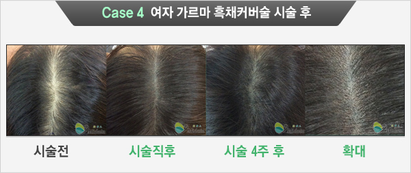Case 4  여자 가르마 흑채커버술 시술 후(시술전, 시술직후, 시술 4주 후, 확대)