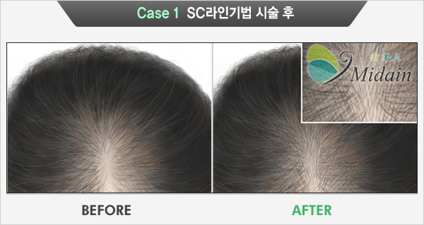 Case 1 SC라인기법 시술 후(BEFORE, AFTER)