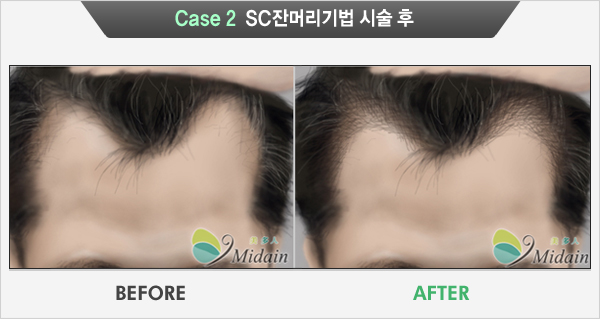 Case 2 SC잔머리기법 시술 후(BEFORE, AFTER)