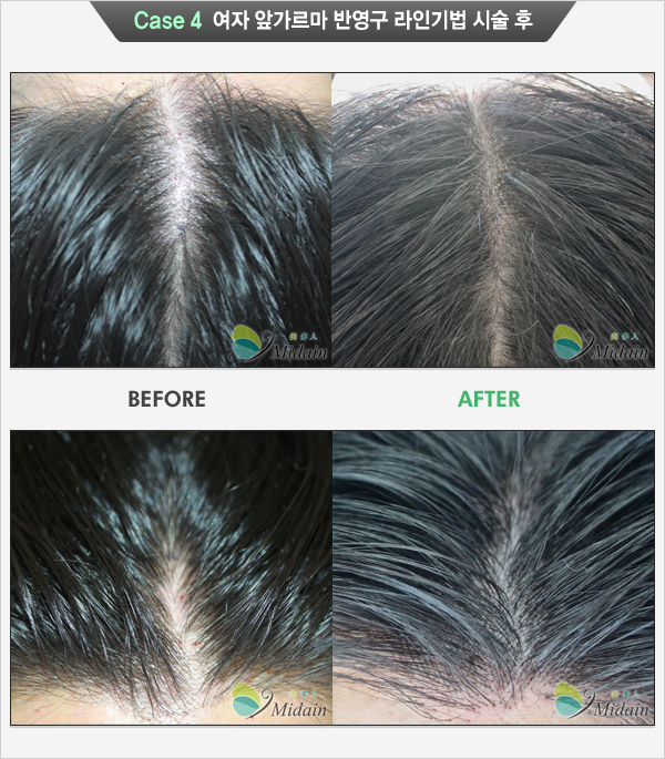 Case 4 여자 앞가르마 반영구 라인기법 시술 후(BEFORE, AFTER)