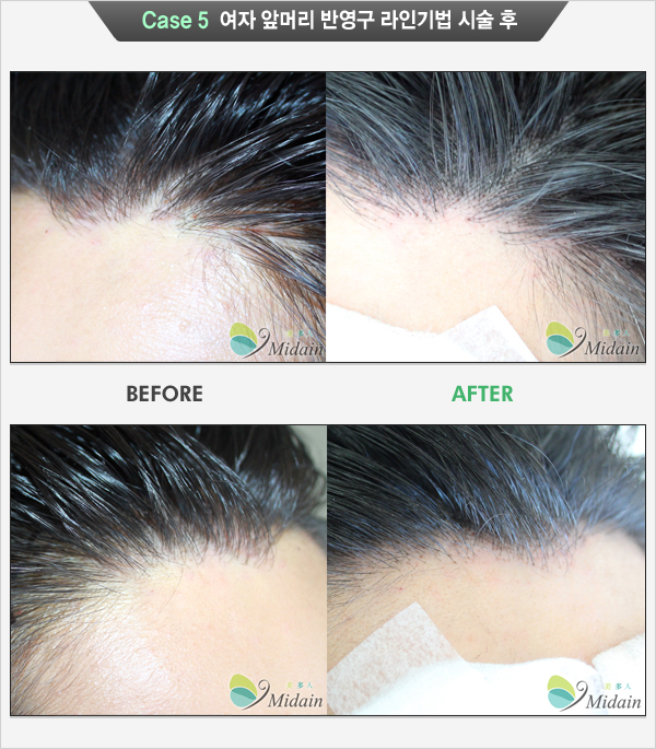 Case 5 여자 앞머리 반영구 라인기법 시술 후(BEFORE, AFTER)