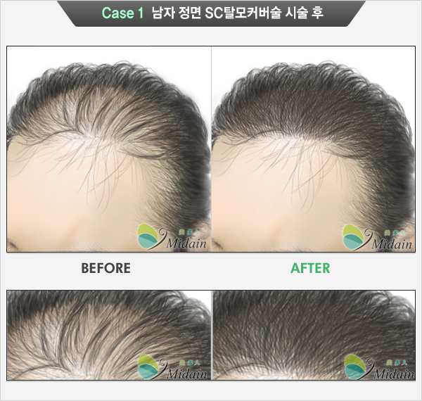 Case 1 남자 SC탈모커버술 시술 후(BEFORE, AFTER)