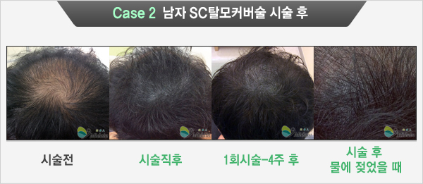 Case 2 남자 SC탈모커버술 시술 후(시술전, 시술직후, 1회시술-4주후, 시술 후 물에 젖었을 때)