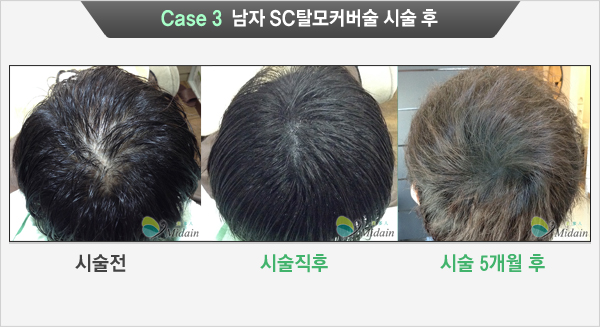 Case 3 남자 SC탈모커버술 시술 후(시술전, 시술직후, 시술 5개월 후)