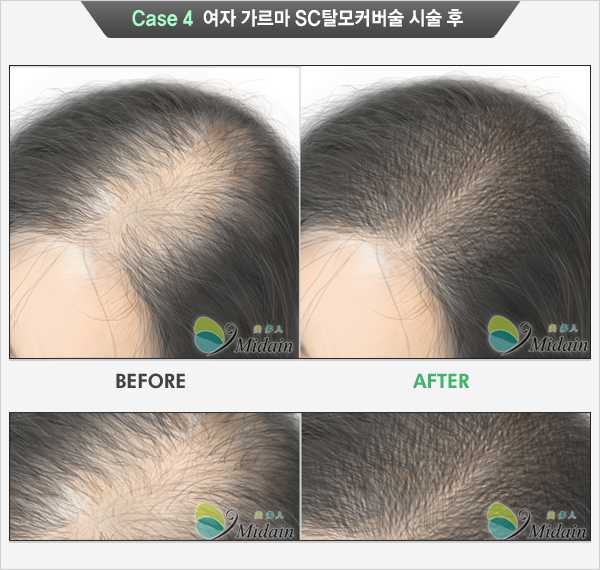 Case 4 여자 여자 가르마 SC탈모커버술 시술 후(BEFORE, AFTER)