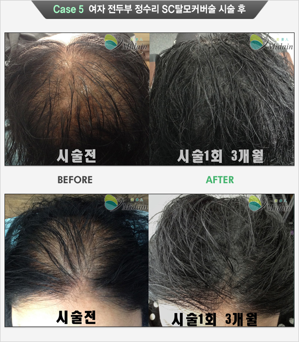 Case 5 여자 전두부 정수리 SC탈모커버술 시술 후(시술전, 시술1회 3개월)