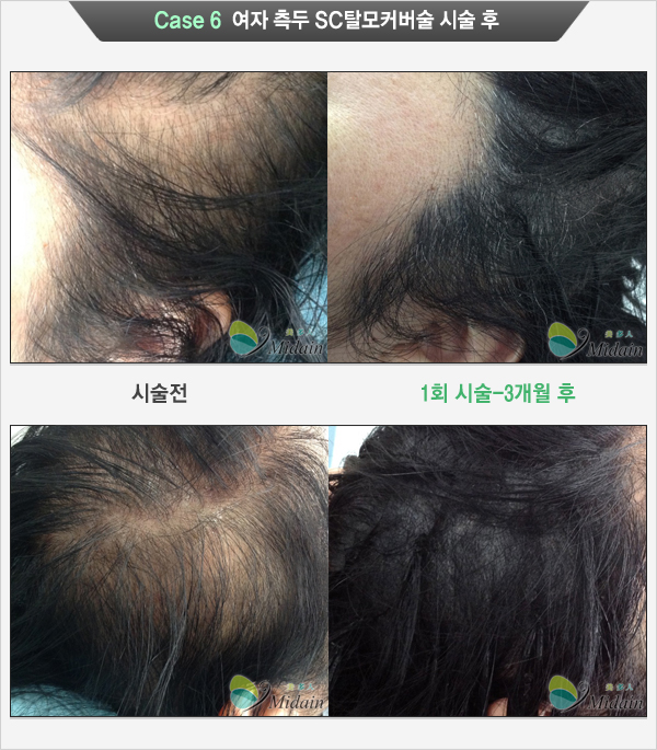 Case 6 여자 측두 SC탈모커버술 시술 후(시술전, 1회시술-3개월 후)