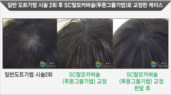 Case 1 일반도트기법 시술 1회 후 SC탈모커버술(투톤그물기법)로 교정한 케이스