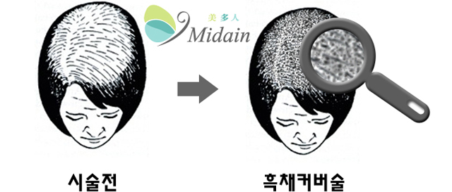 시술전, 흑채커버술 이미지