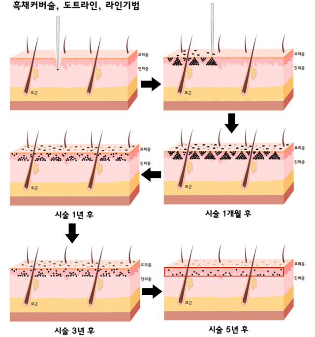 흑채커버술, 도트라인, 라인기법(시술 1개월 후, 시술 1년 후, 시술 3년 후, 시술 5년후 경과 과정 이미지)