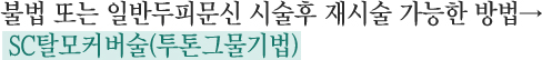 불법 또는 일반두피문신 시술후 재시술 가능한 방법→ SC탈모커버술(투톤그물기법)