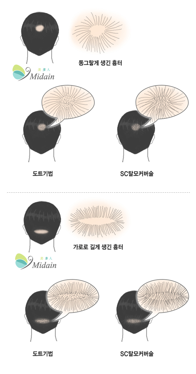 동그랗게 생긴흉터와 가로로 길게 생긴 흉터에 따른 도트기법, SC탈모커버술 이미지